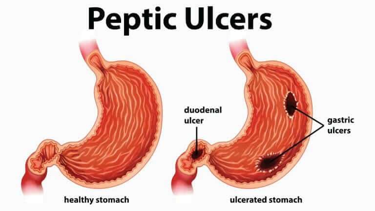 GI Vital Softgel For Ulcers, Reflux &  Hepatitis