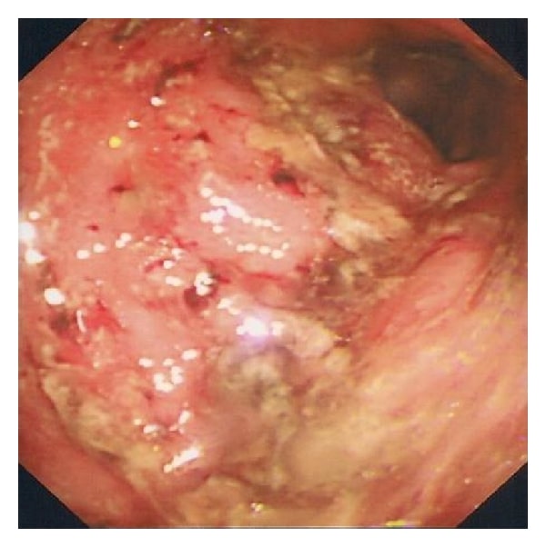 Haemorrhagic Colitis Caused by Dasatinib