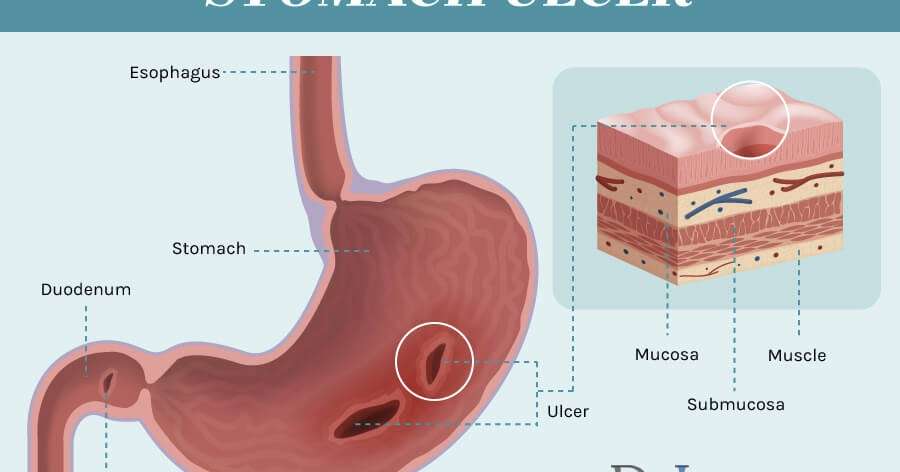 Heal Stomach Ulcer Naturally part 2