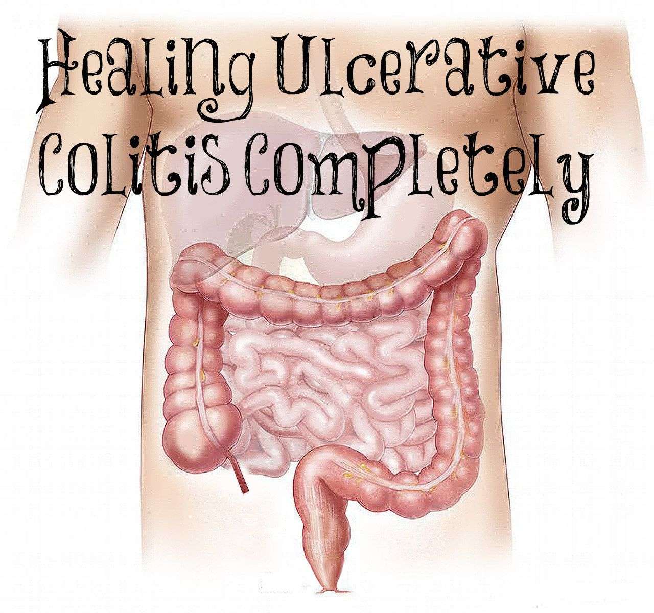 Healing Ulcerative Colitis Completely in 2020