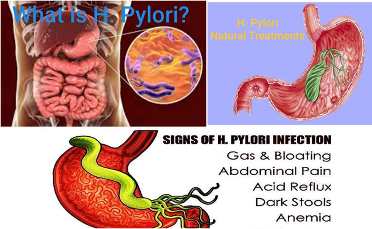 (Helicobacter Pylori) H. Pylori Infection: Causes, Symptom &  Natural ...