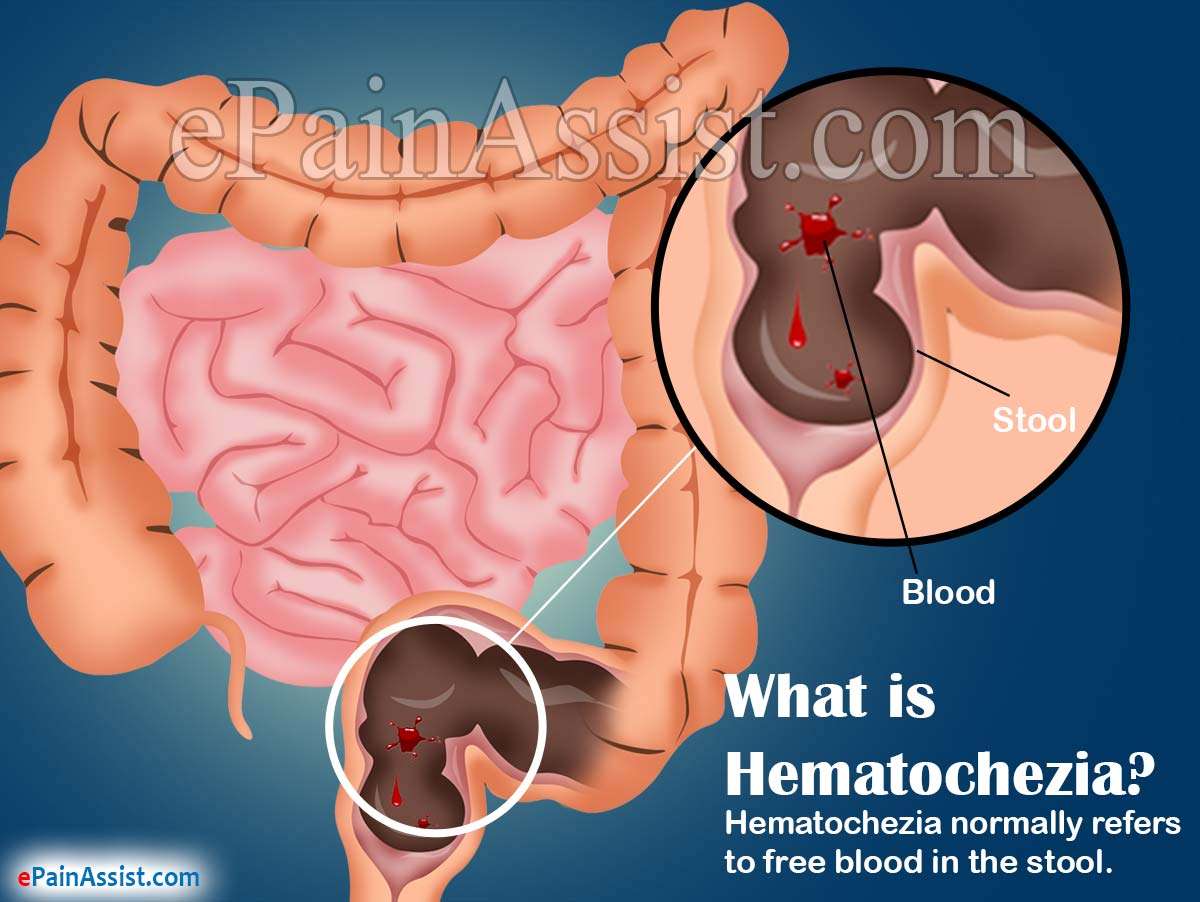 Hematochezia or Blood in Stool