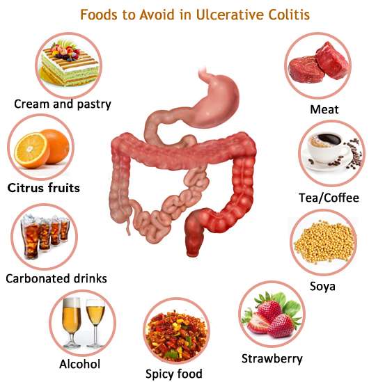 Herbal Remedies: Ayurvedic treatment of Ulcerative colitis