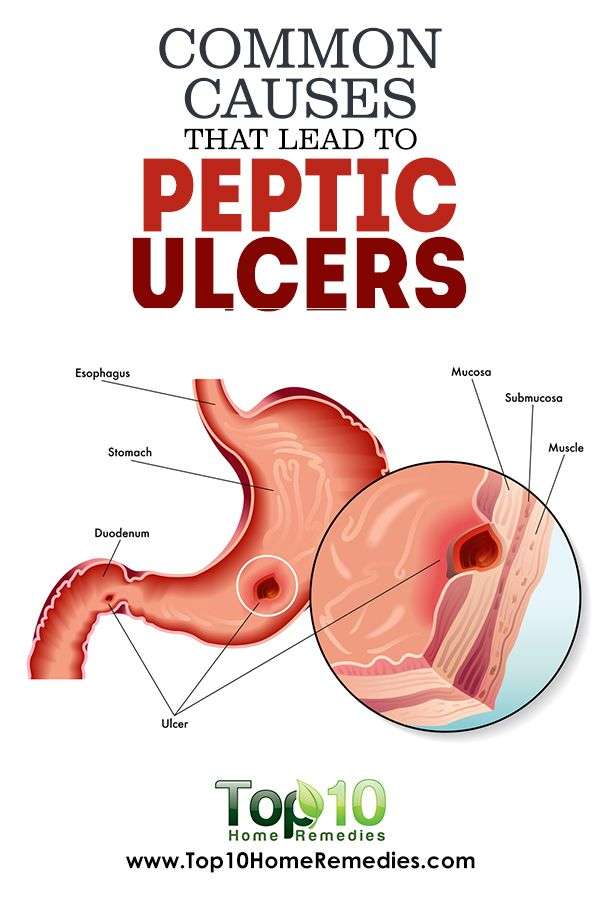 Heres everything that you must know about peptic ulcer ...