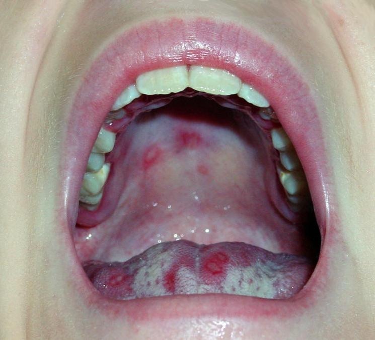 Herpes roof of mouth photos