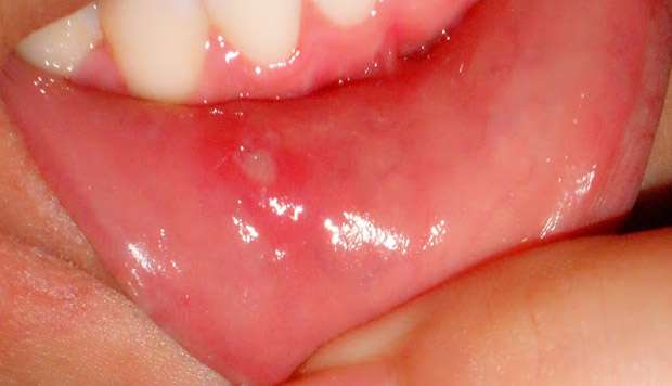Home Remedies For Canker Sores &  Mouth Ulcers