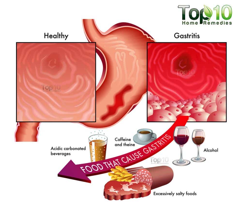 Home Remedies for Gastritis