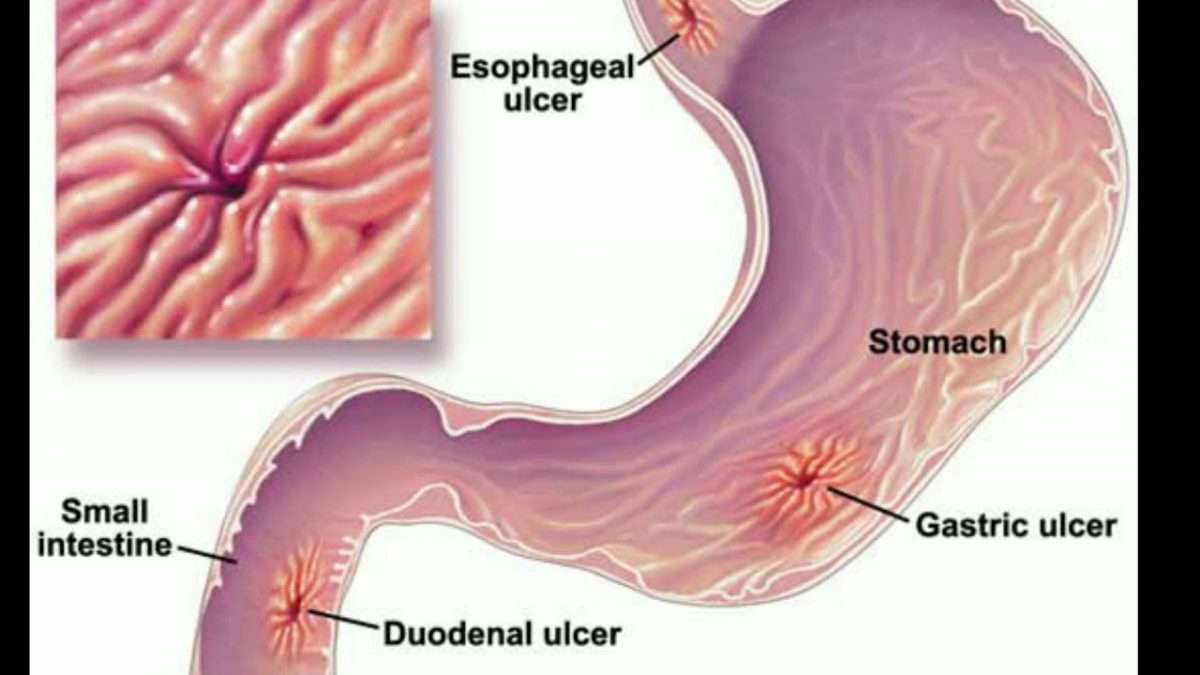 Home Remedy For Stomach Ulcer In Hindi