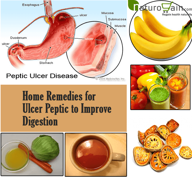 Homemade Treatment For Gastric Ulcer