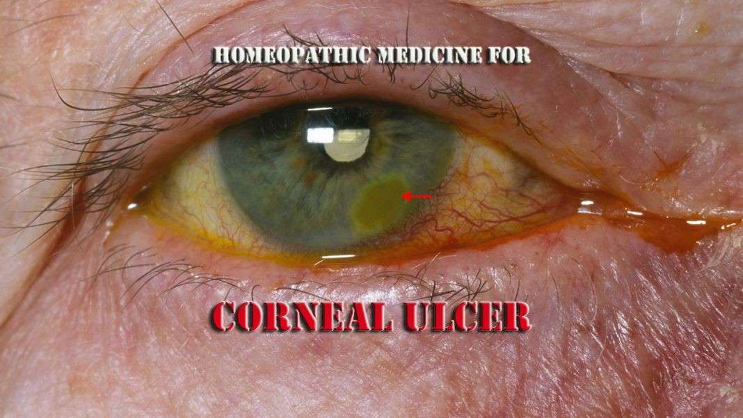 How Do You Treat a Corneal Ulcer at Home