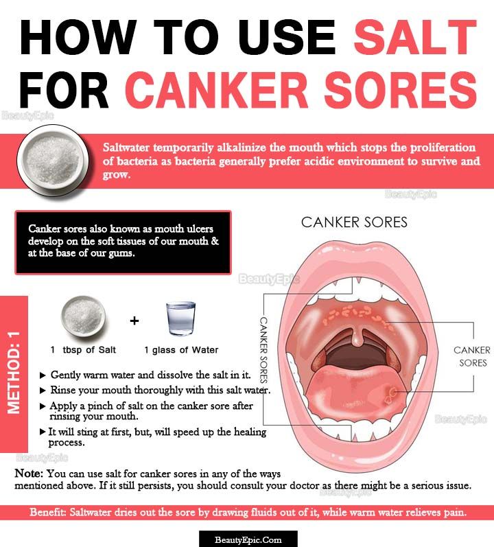 How Does Salt Help Heal Canker Sores?