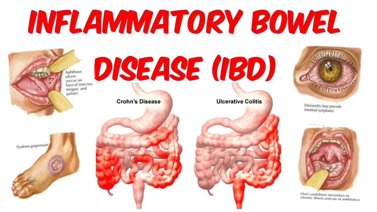 How Inflammatory Bowel Disease Affiliated with ...
