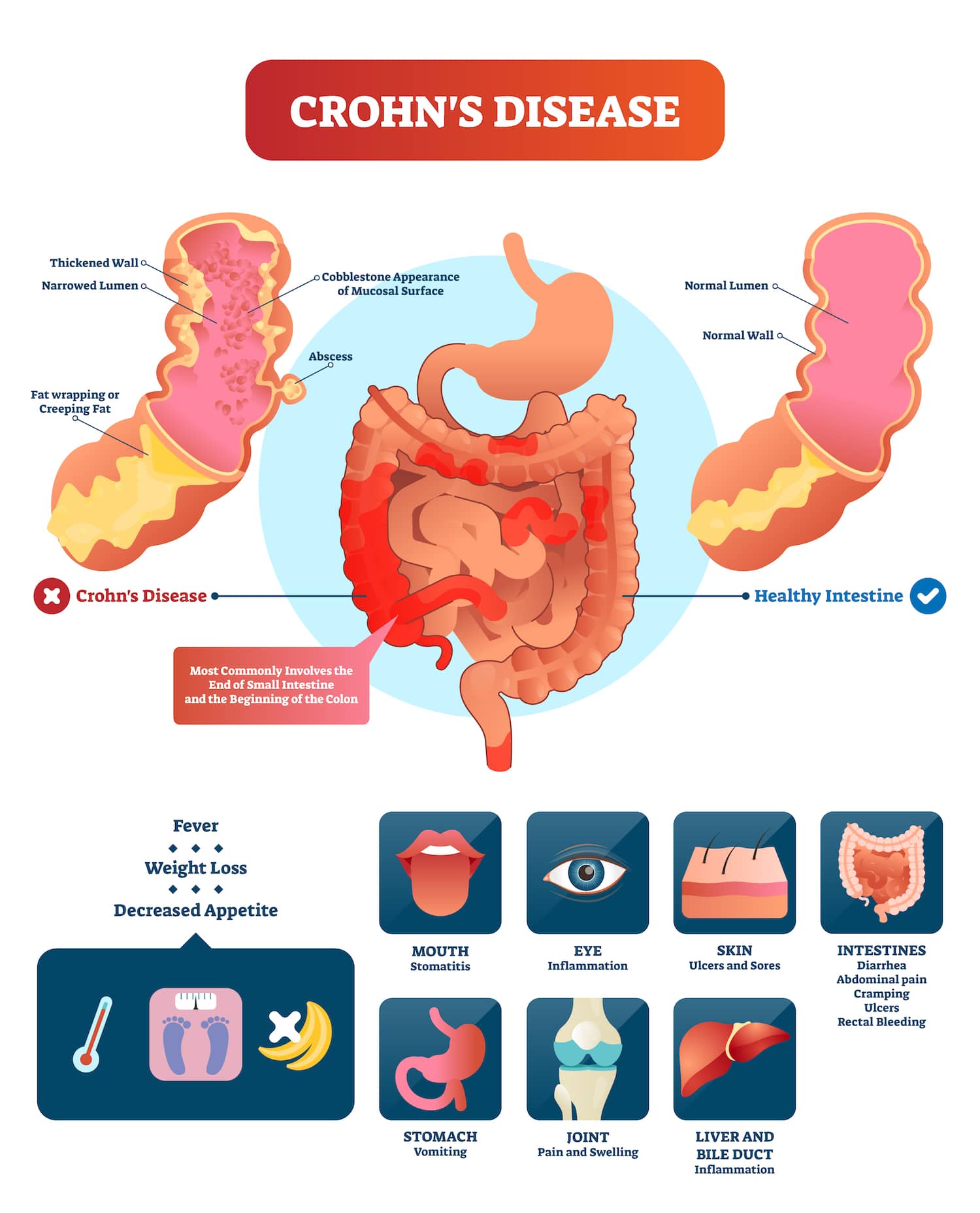 How Is Crohns Diagnosed? Our In