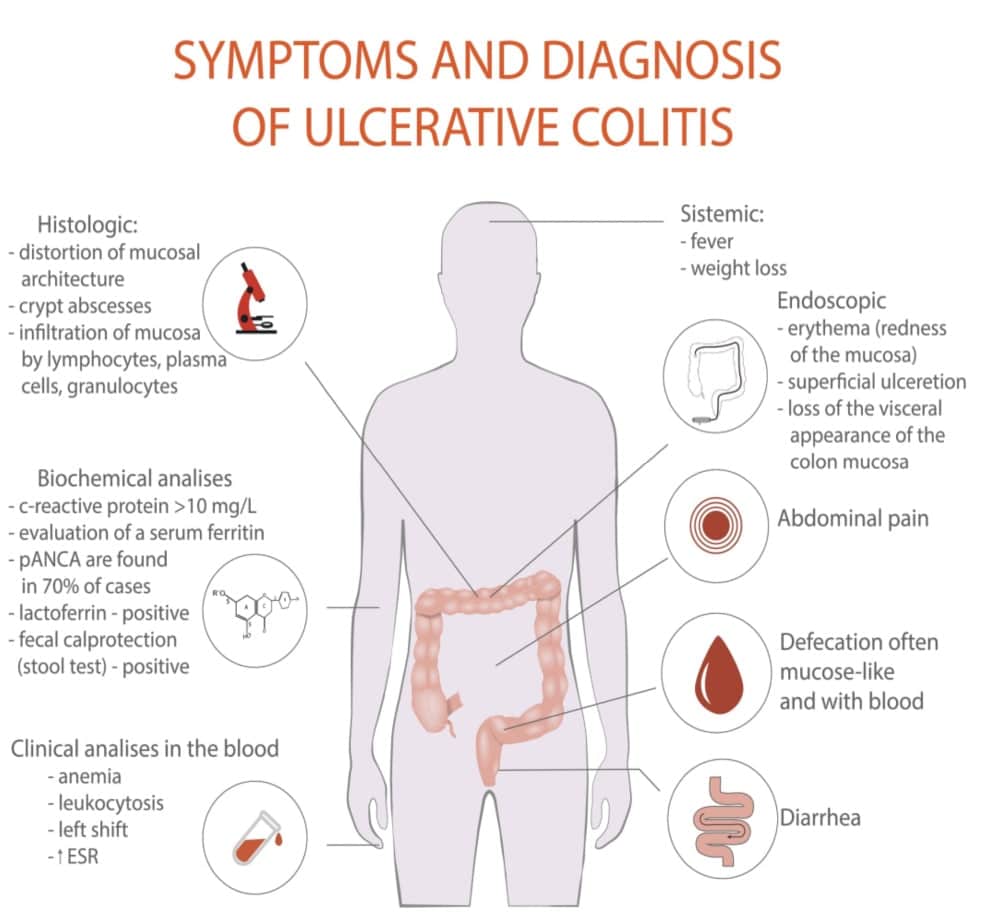 How is Ulcerative Colitis Diagnosed?
