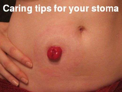 How to Care for Your Stoma After an Ostomy