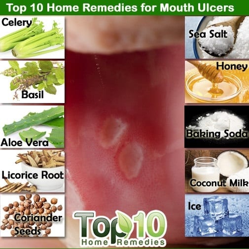 How to cure mouth ulcer in one day