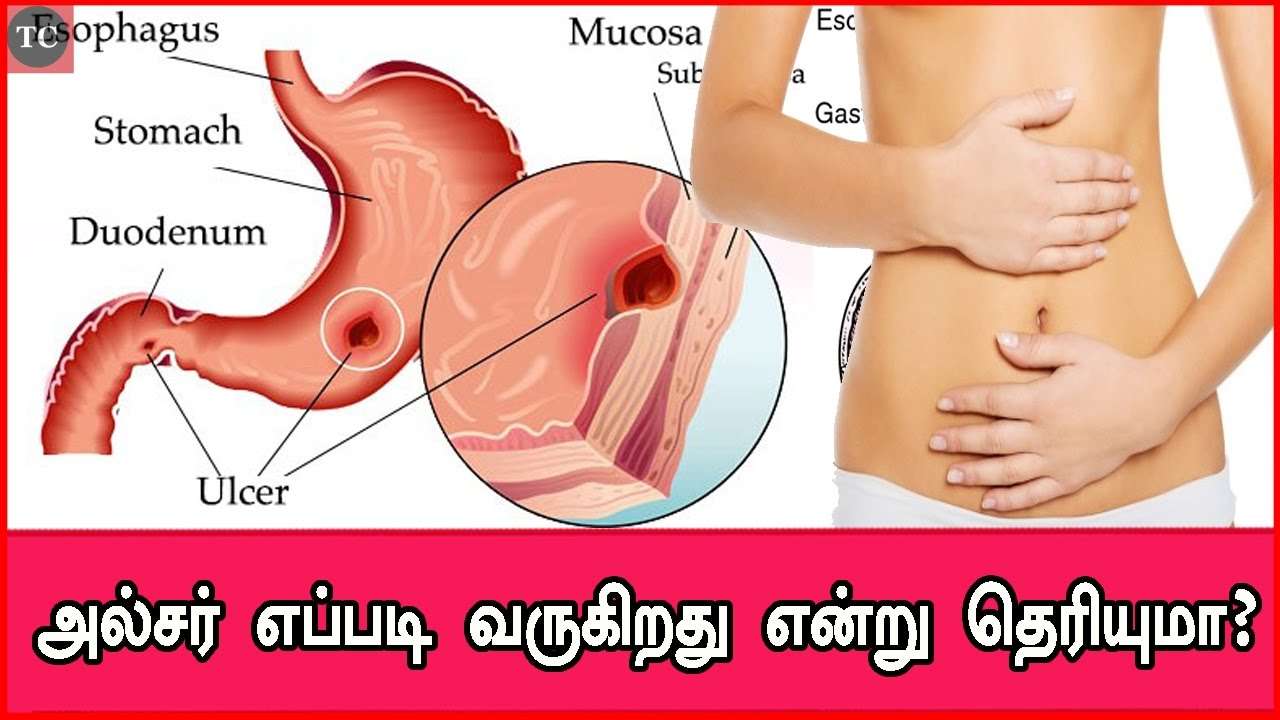 How To Cure Stomach Ulcer Permanently In Tamil