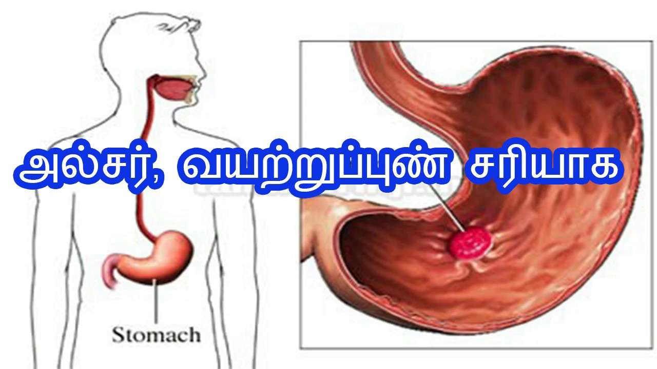How to cure ulcer in stomach naturally in tamil ...