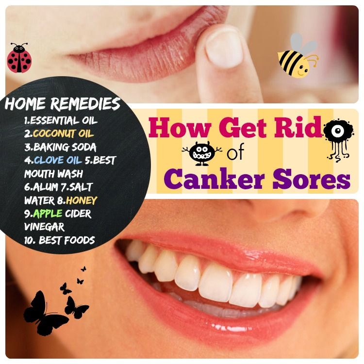 How to get rid of canker sores: 1.Essential oil 2.Coconut OIl 3.Baking ...