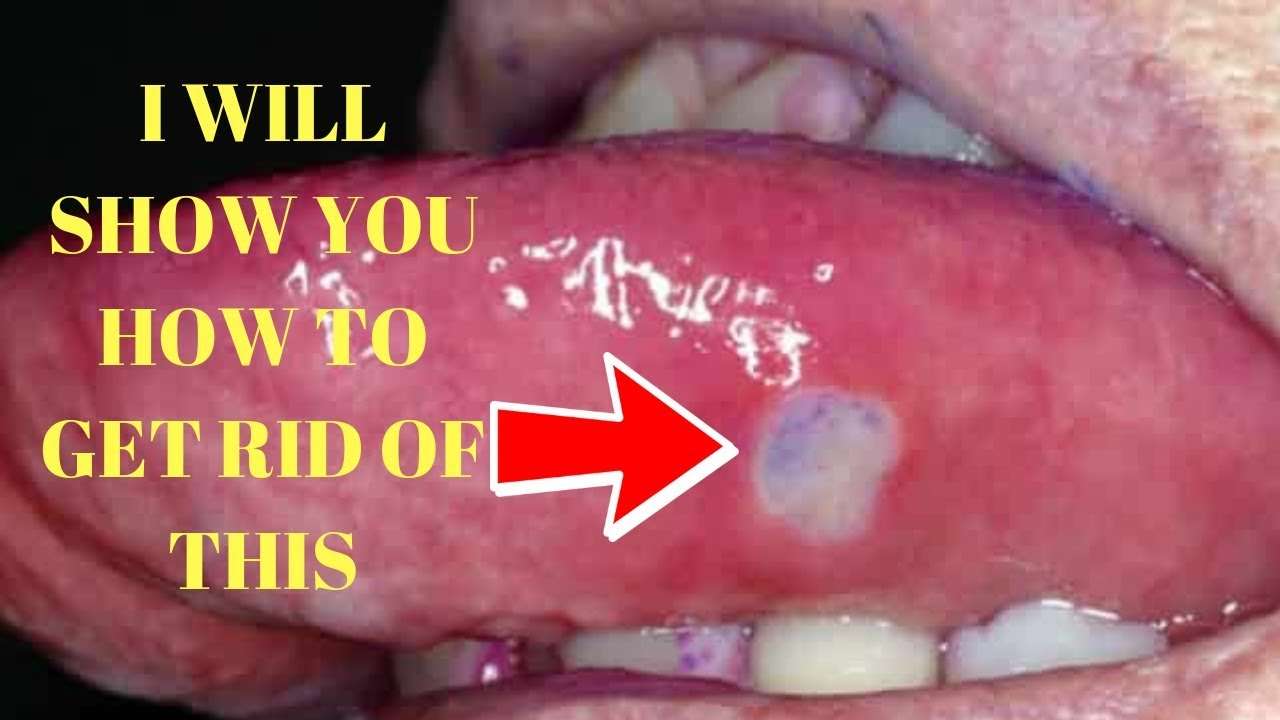 how to get rid of canker sores on tongue (canker sores in ...