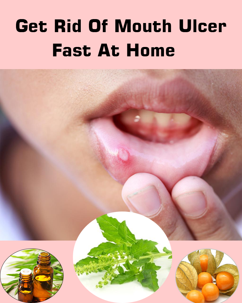How To Get Rid Of Mouth Ulcer Fast