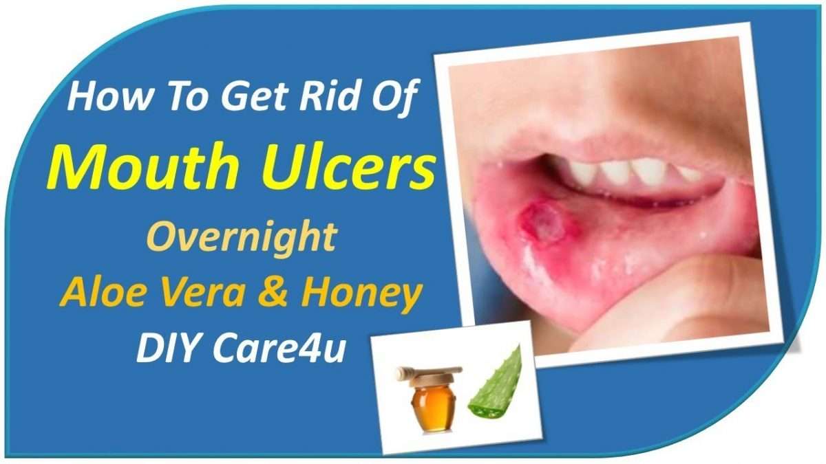 how-to-get-rid-of-mouth-ulcers-overnight-ulcertalk-2022