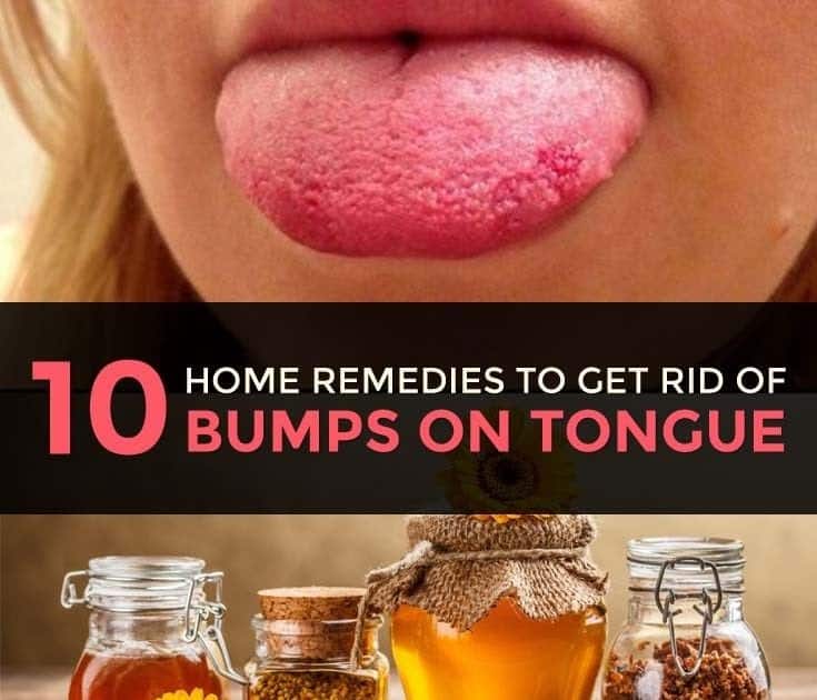 How To Get Rid Of Sore In Tongue