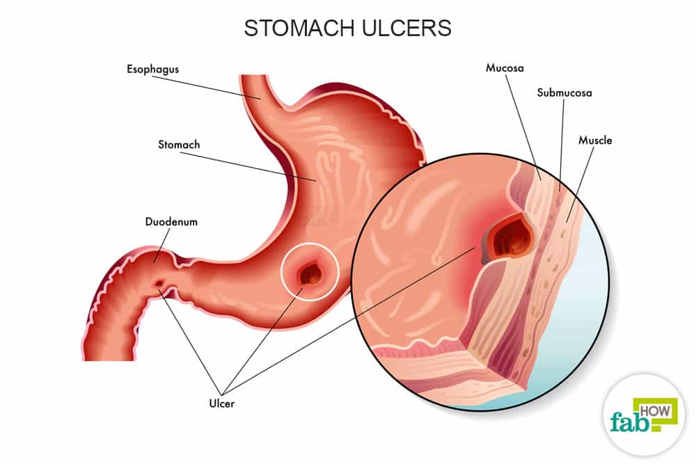 How to Get Rid of Stomach Ulcers (Heal Fast with Home Remedies)