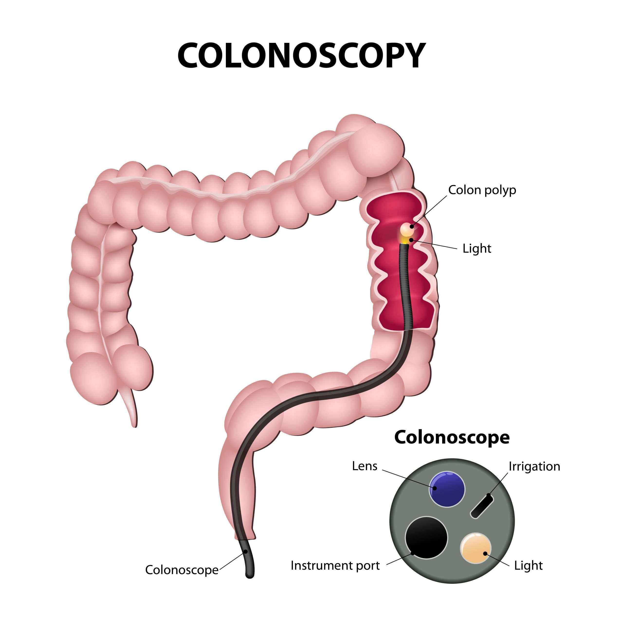 How to Know if You Have Colitis