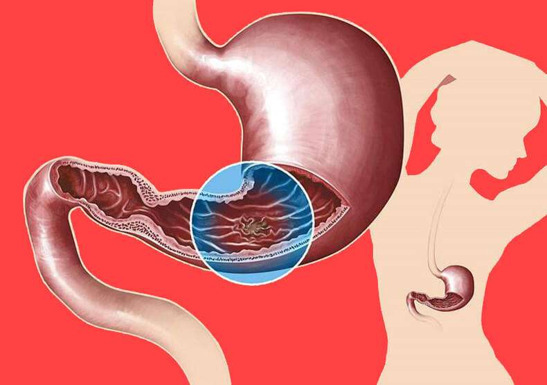 How to know if you have ULCER