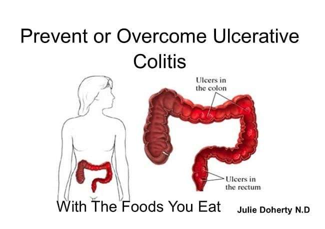 How to Manage &  Heal Ulcerative Colitis with Positive Diet &  Lifestyle ...