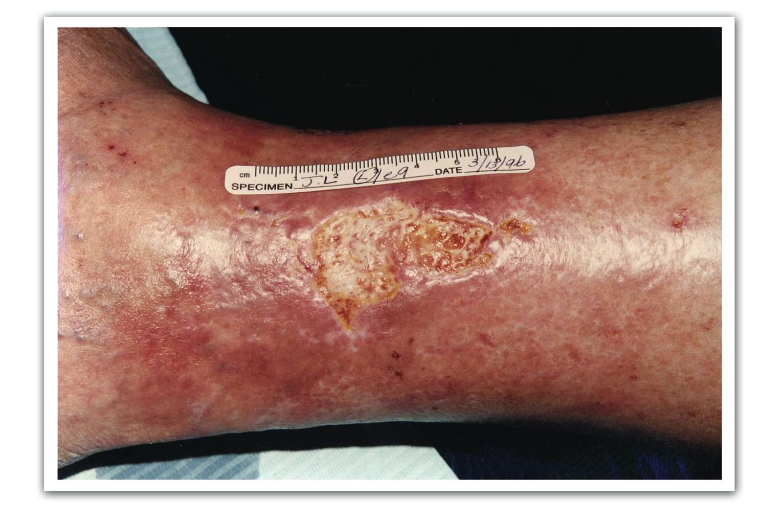 How To Manage Venous Stasis Ulcers