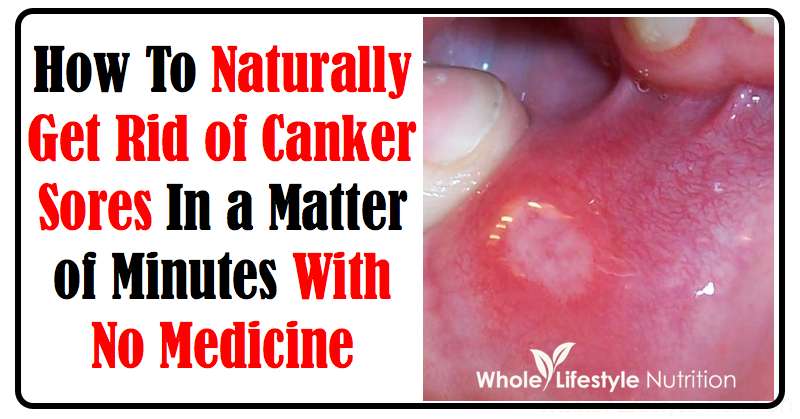 How To Naturally Get Rid of Canker Sores