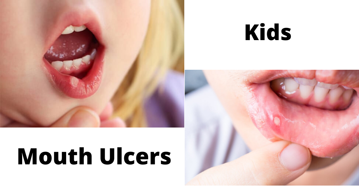 How to Prevent Mouth ulcers in child