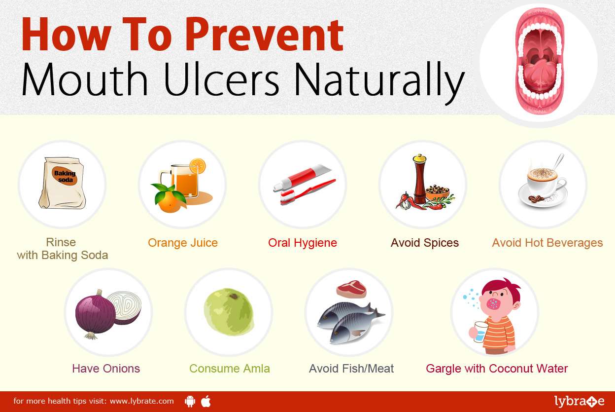 How To Prevent Mouth Ulcers Naturally