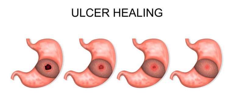 How to Soothe Stomach Ulcers Using Natural Remedies