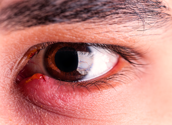 How To Treat and Prevent a Stye in Your Eye