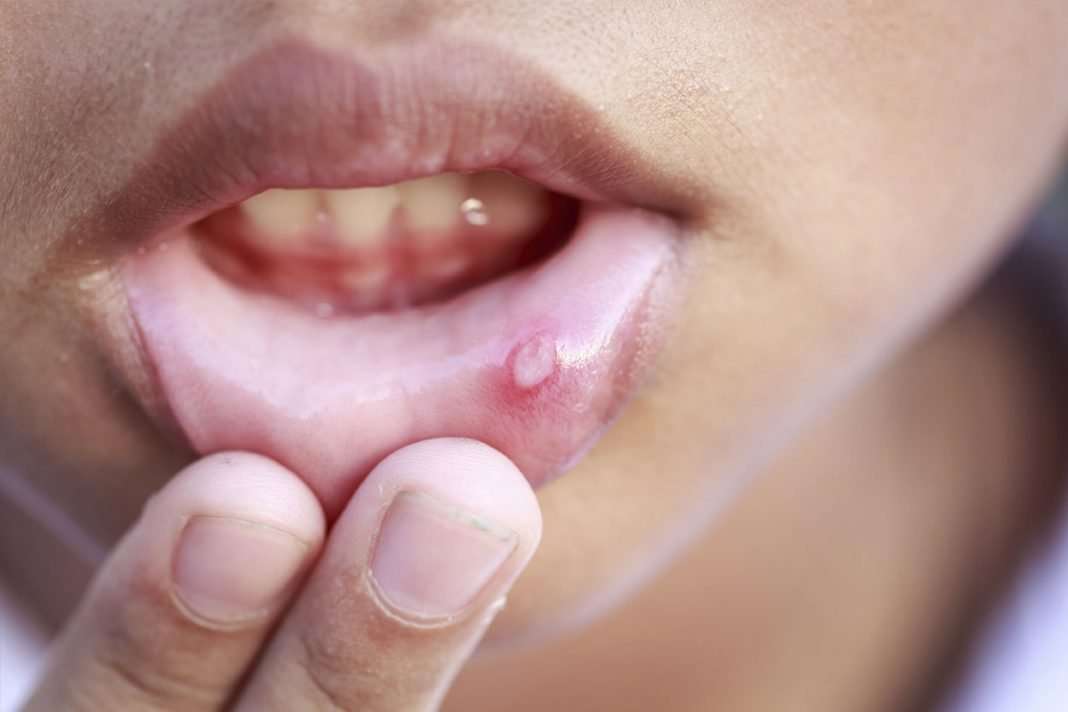 How to Treat Mouth Ulcer?