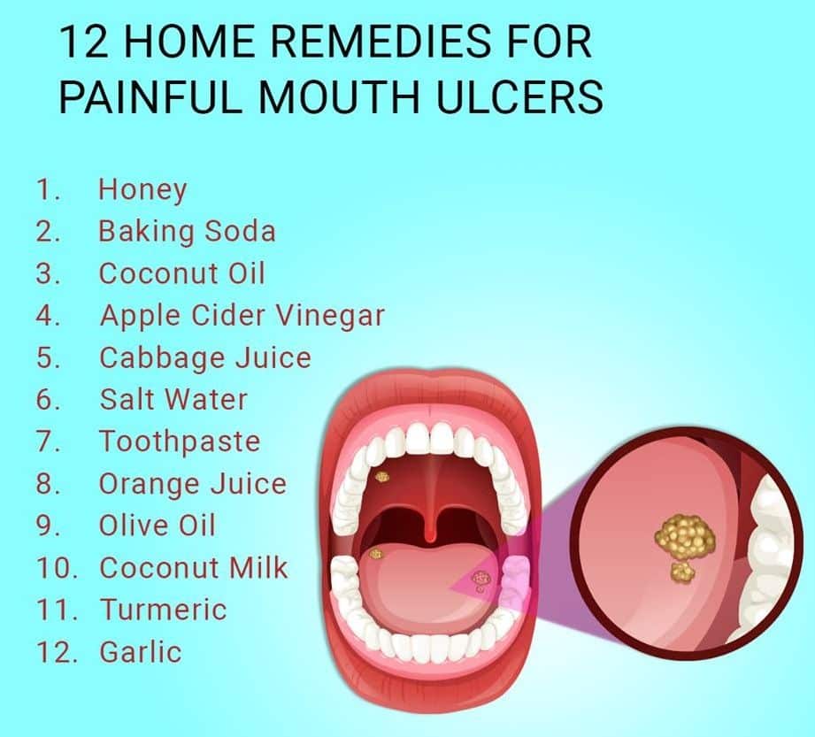 How To Treat Mouth Ulcers Salt Water â ho.modulartz.com