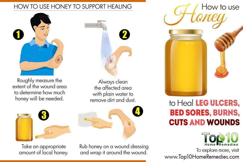 How to Use Honey to Heal Leg Ulcers, Bed Sores, Burns, Cuts and Wounds ...