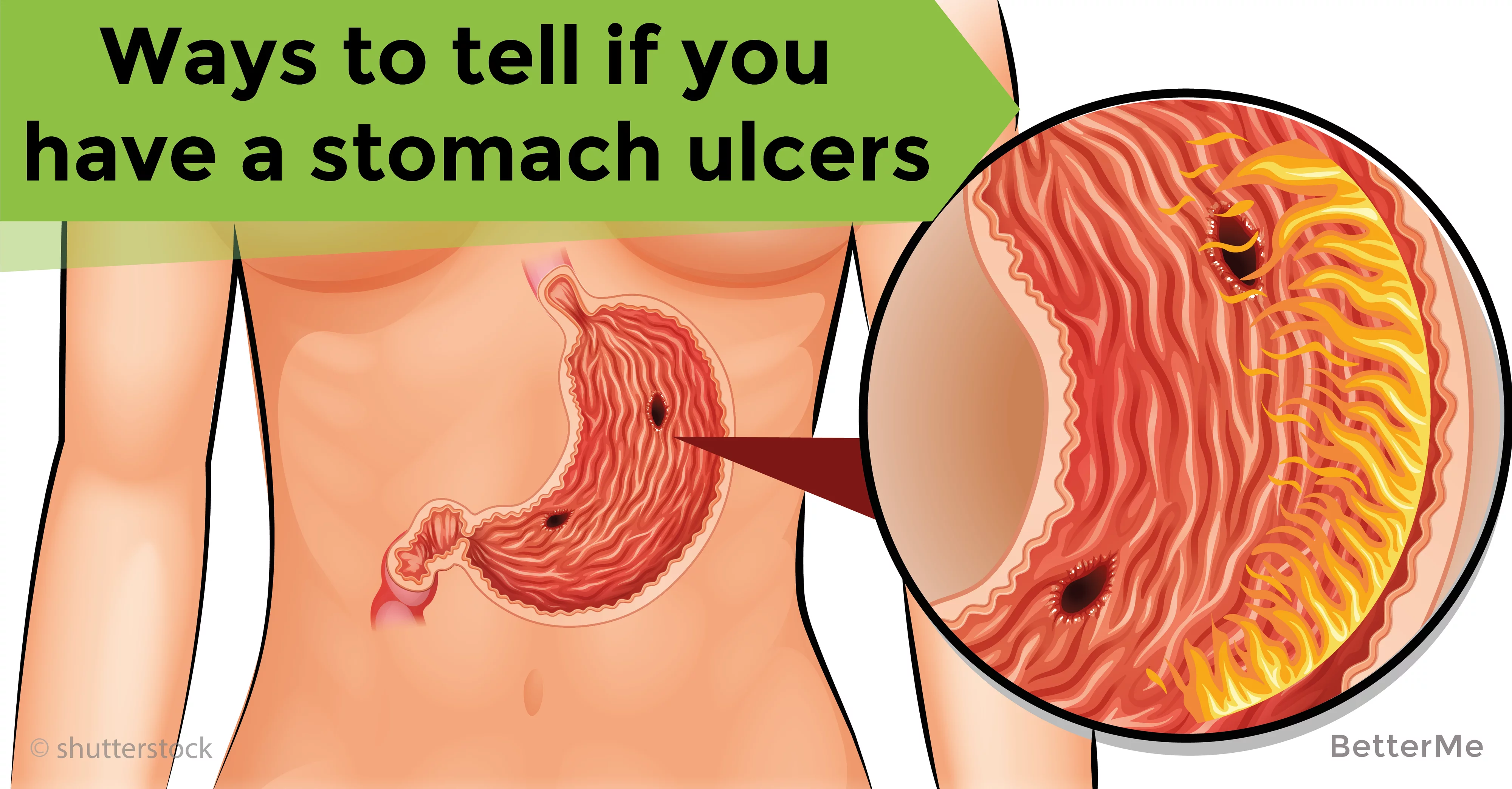 How you can spot stomach ulcers and what to do about them