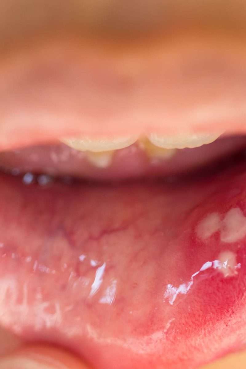HPV in the mouth: Symptoms, causes, and treatment