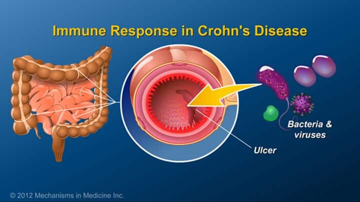 In Crohns disease, inflammation (ulcers) appear within the GI tract ...