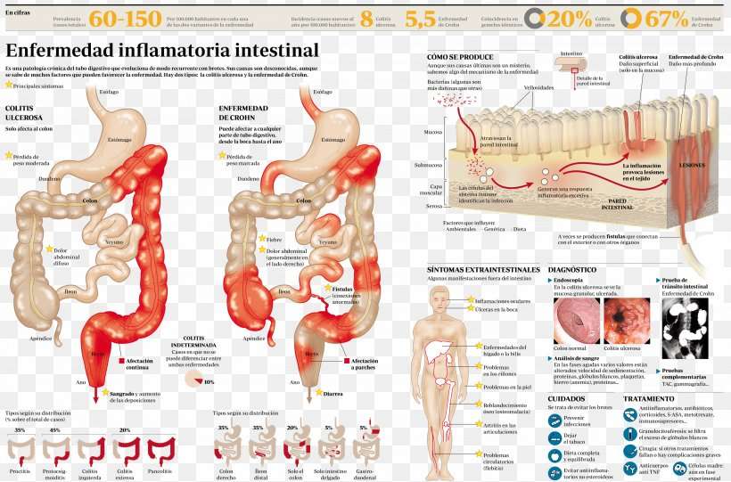 Inflammatory Bowel Disease Crohn