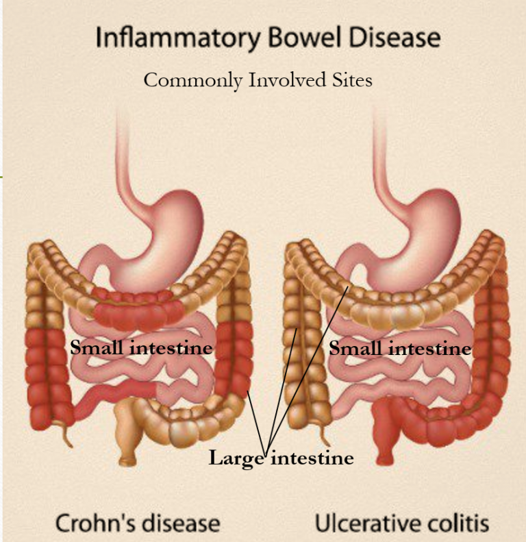 Inflammatory Bowel Disease (IBD) Awareness