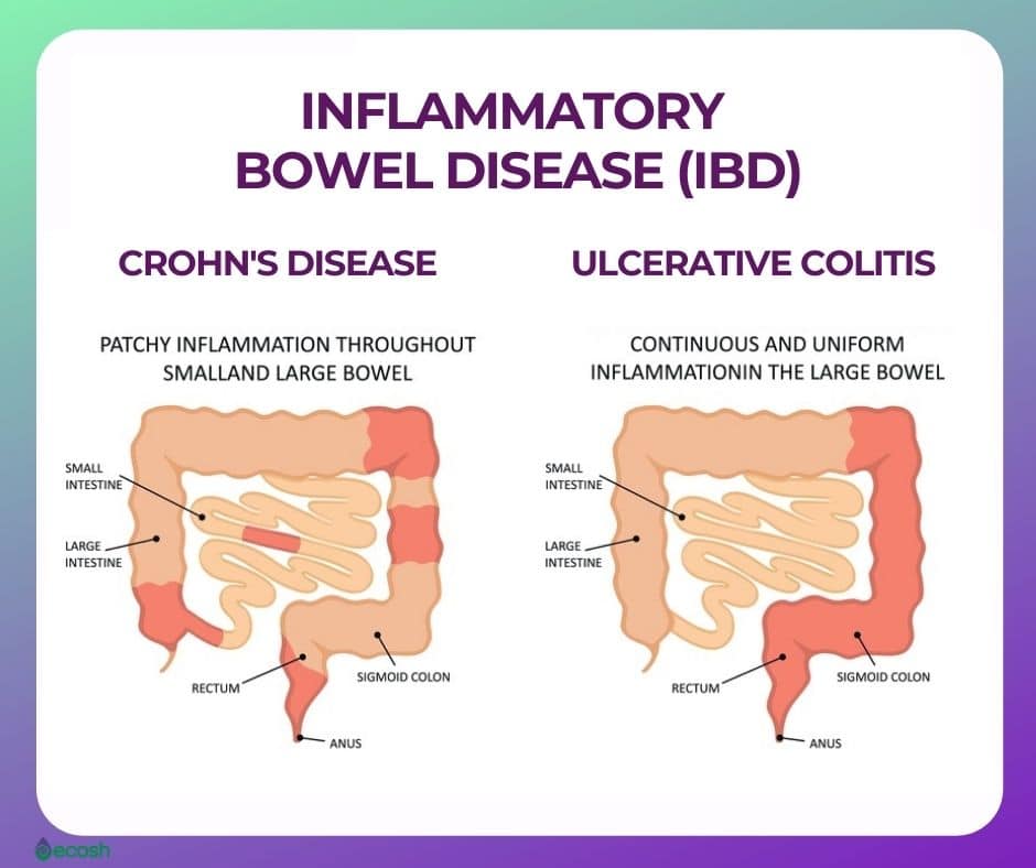 INFLAMMATORY BOWEL DISEASE (IBD)