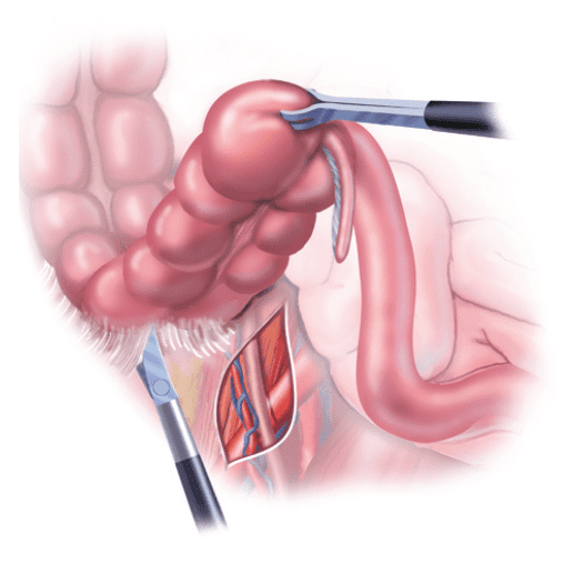 Laparoscopic Colon Resection Patient Information from SAGES