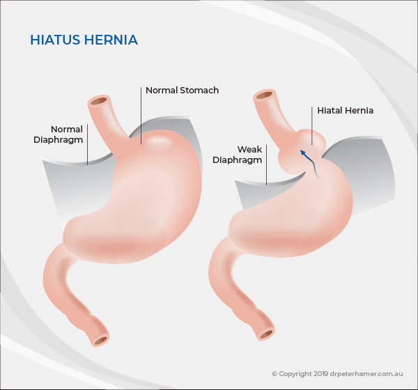 Laparoscopic Hiatus Hernia Repair