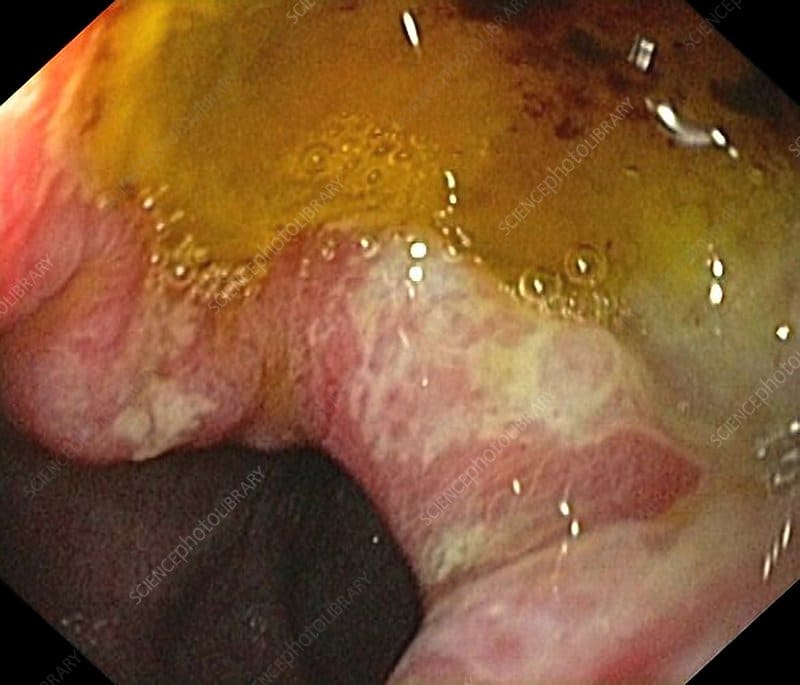 Large duodenal ulcer