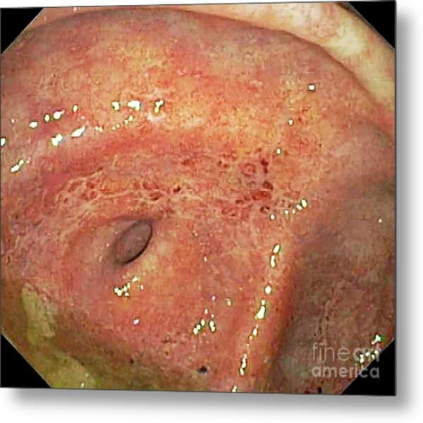 Large Intestine In Ulcerative Colitis Photograph by Gastrolab/science ...